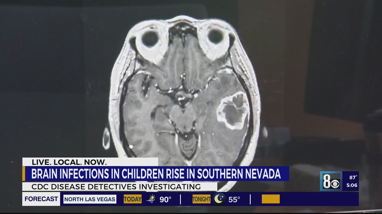 Clark County Sees Spike In Rare Brain Infection, Cdc Says