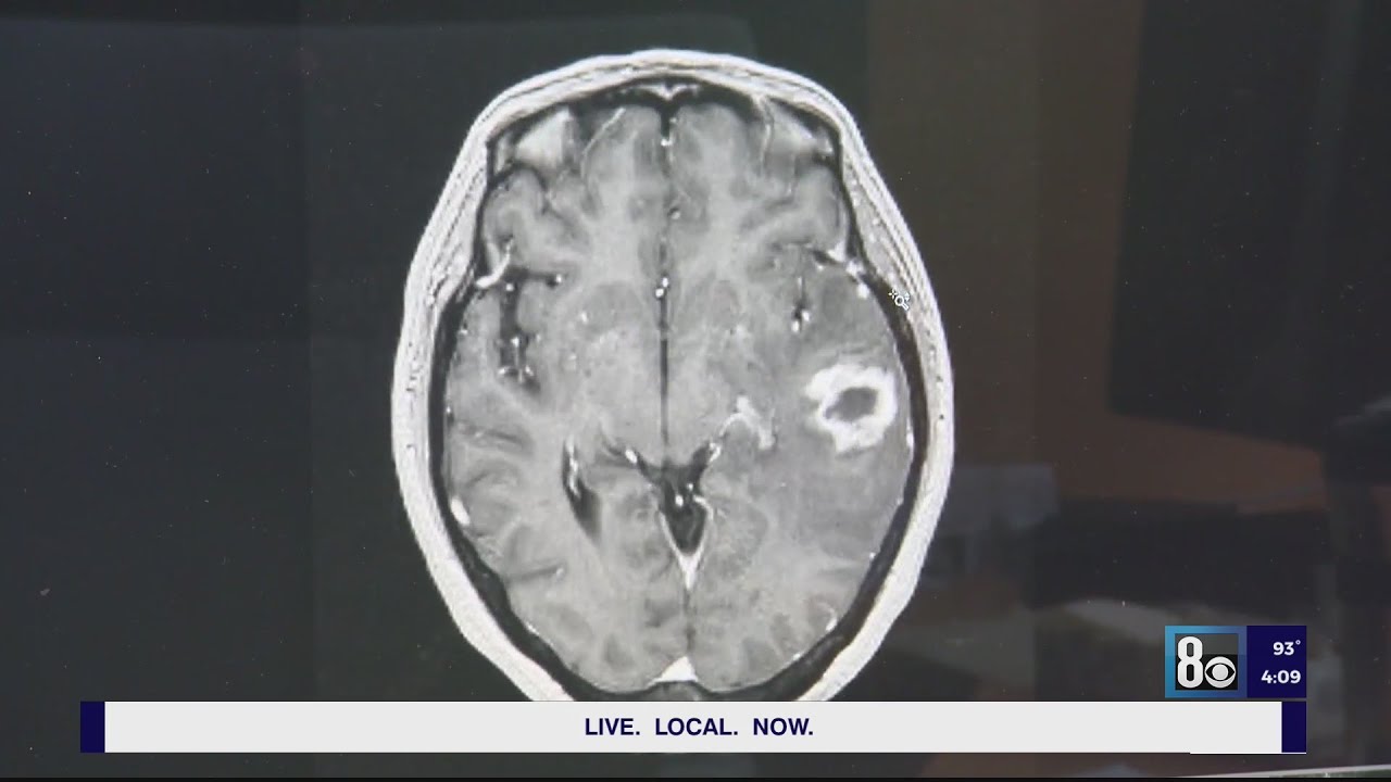 Doctor Offers Hypothesis On What’s Causing Brain Abscesses In Southern Nevada Children