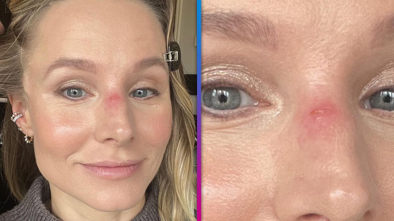 Kristen Bell Shows Off Battle Wound From Daughter