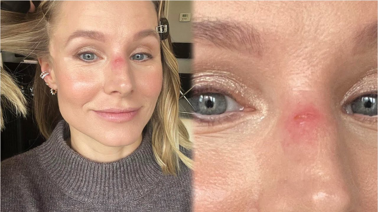 Kristen Bell Suffers Jujitsu Injury From Daughter’s “sharp Buck Teeth”