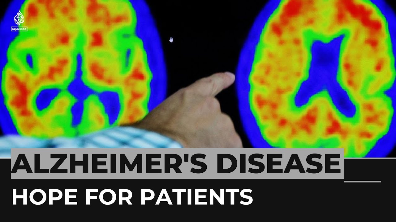 ‘remarkable’ Drug Reduces Alzheimer’s Decline, Study Shows